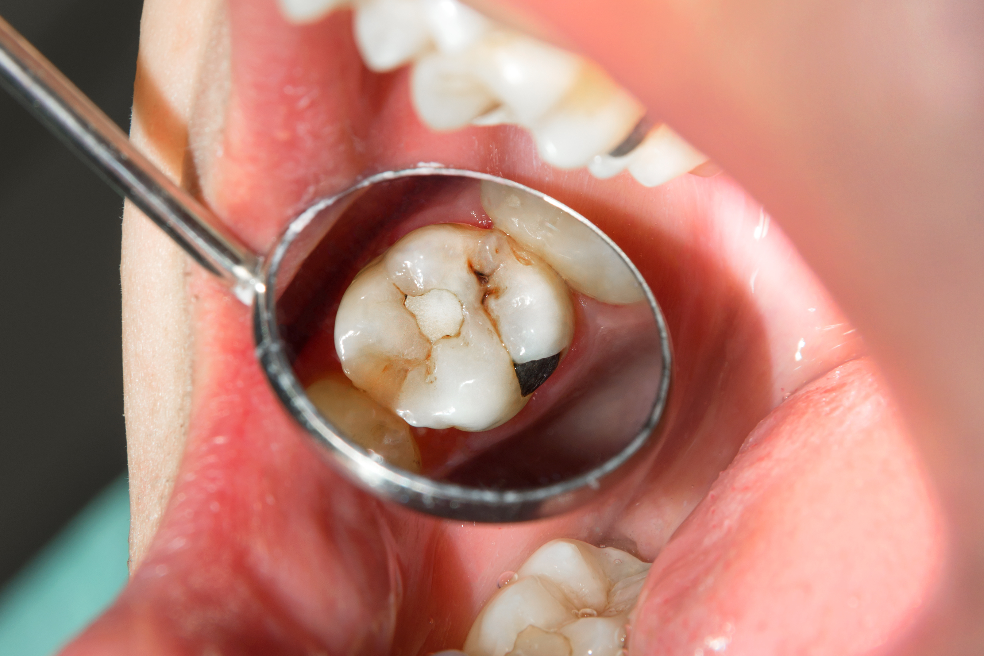 虫歯の最近について