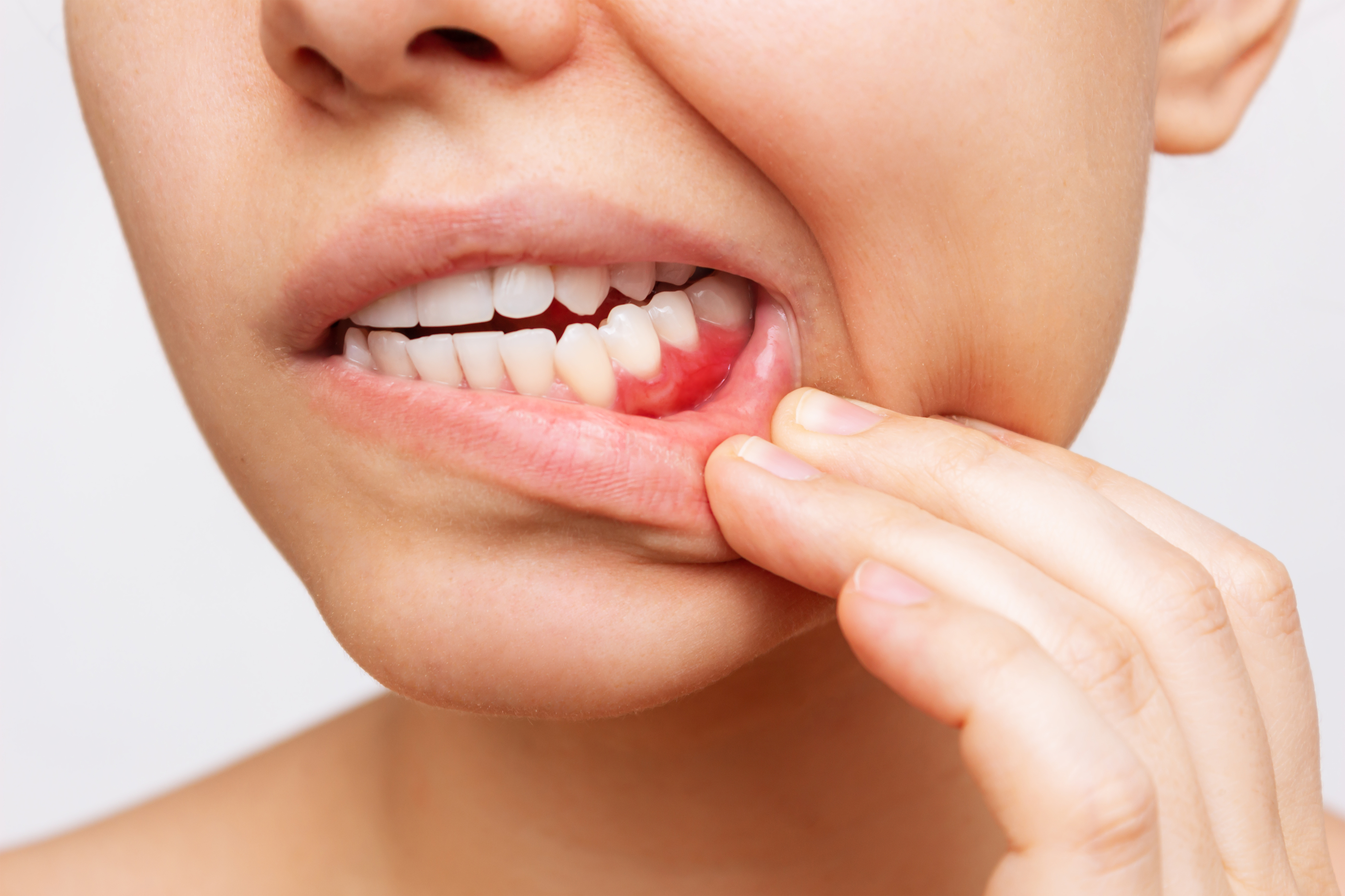虫歯の症状について