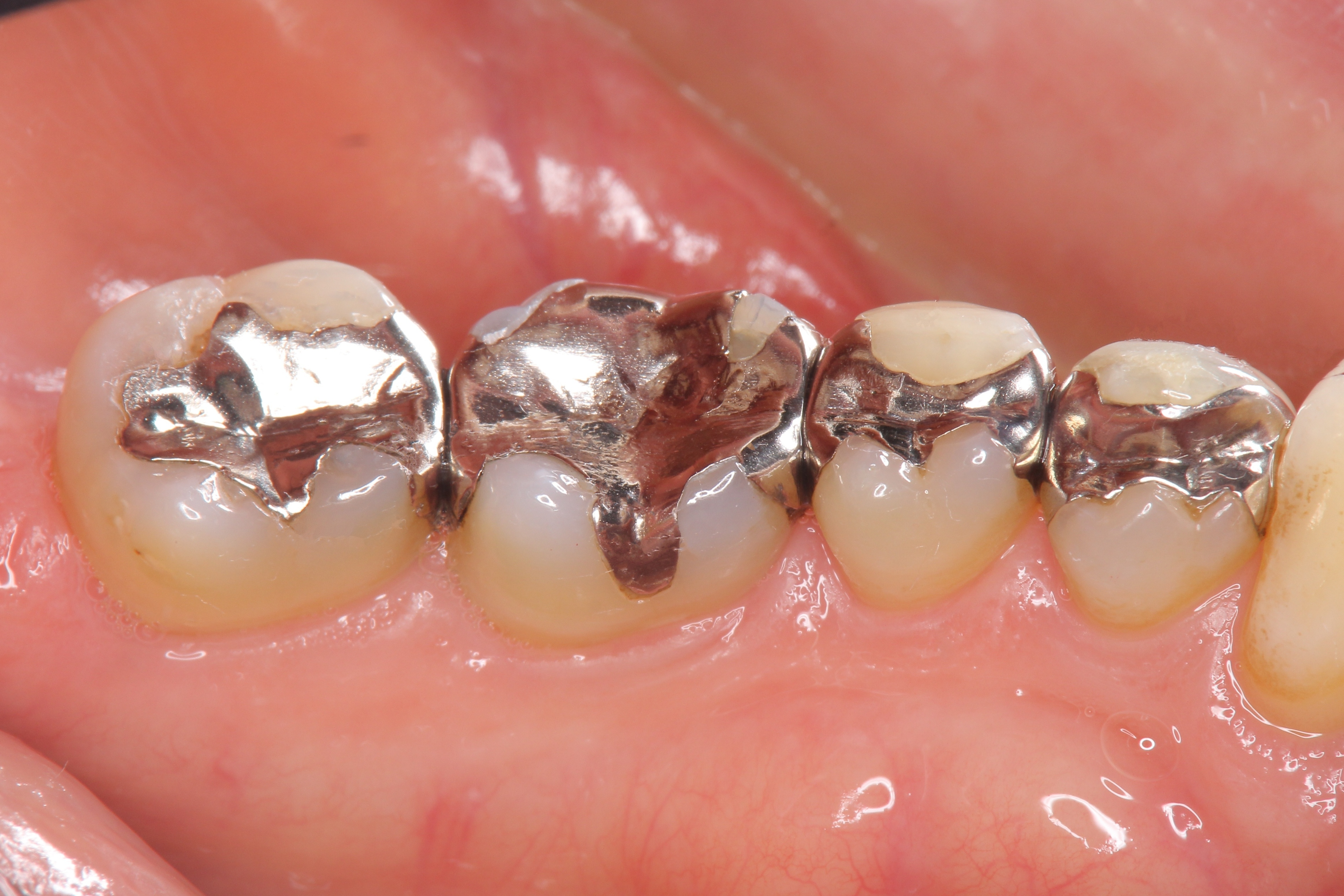 人工歯に使われる材質