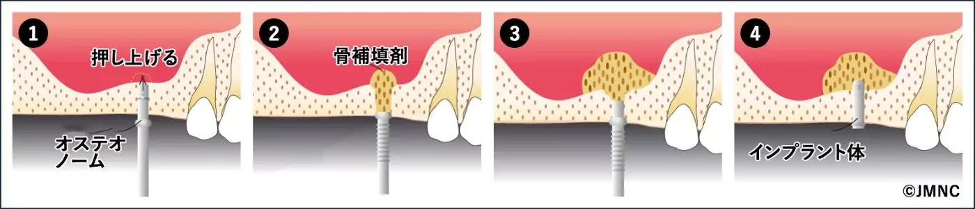 サイナスリフト法（上顎洞底挙上術）